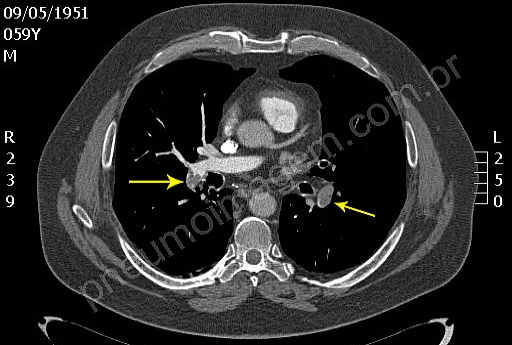 ANTÍDOTO PARA OS NOVOS ANTICOAGULANTES ORAIS EM DESENVOLVIMENTO ANTÍDOTO PARA OS NOVOS ANTICOAGULANTES ORAIS EM DESENVOLVIMENTO